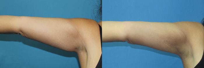 Before & After Liposuction - Arms / Axillary Case 190 Ride Front - Straight out View in Coeur d'Alene, ID