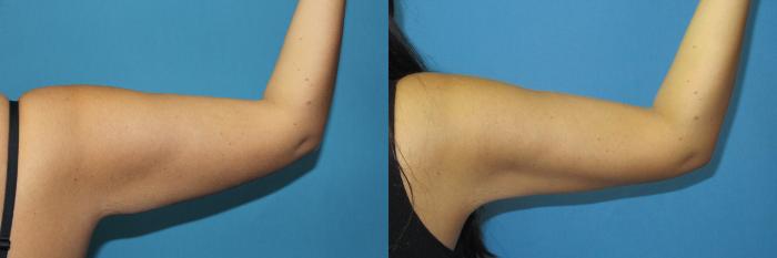 Before & After Liposuction - Arms / Axillary Case 190 Right Back - Flexed View in Coeur d'Alene, ID