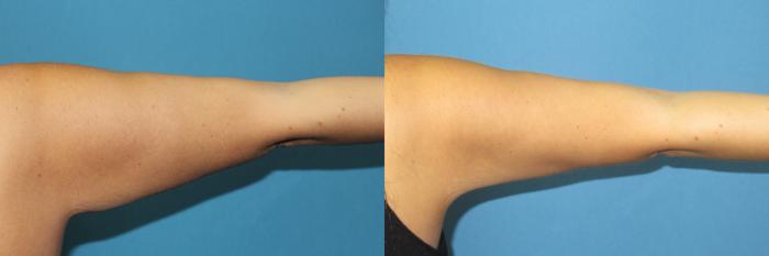 Before & After Liposuction - Arms / Axillary Case 190 Right Back - Straight View in Coeur d'Alene, ID