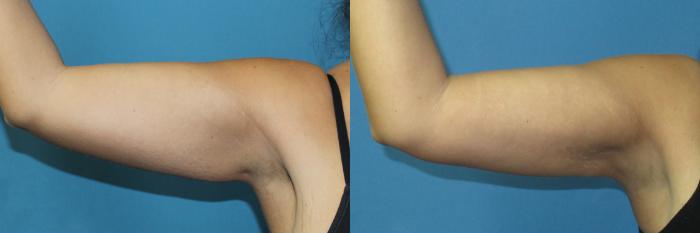 Before & After Liposuction - Arms / Axillary Case 190 Right Front - Flexed View in Coeur d'Alene, ID