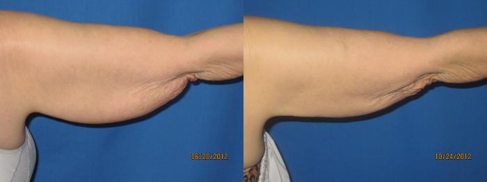Liposuction - Arms / Axillary Before and After Pictures Case 48
