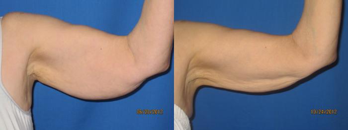 Before & After Liposuction - Arms / Axillary Case 31 View #2 View in Coeur d'Alene, ID