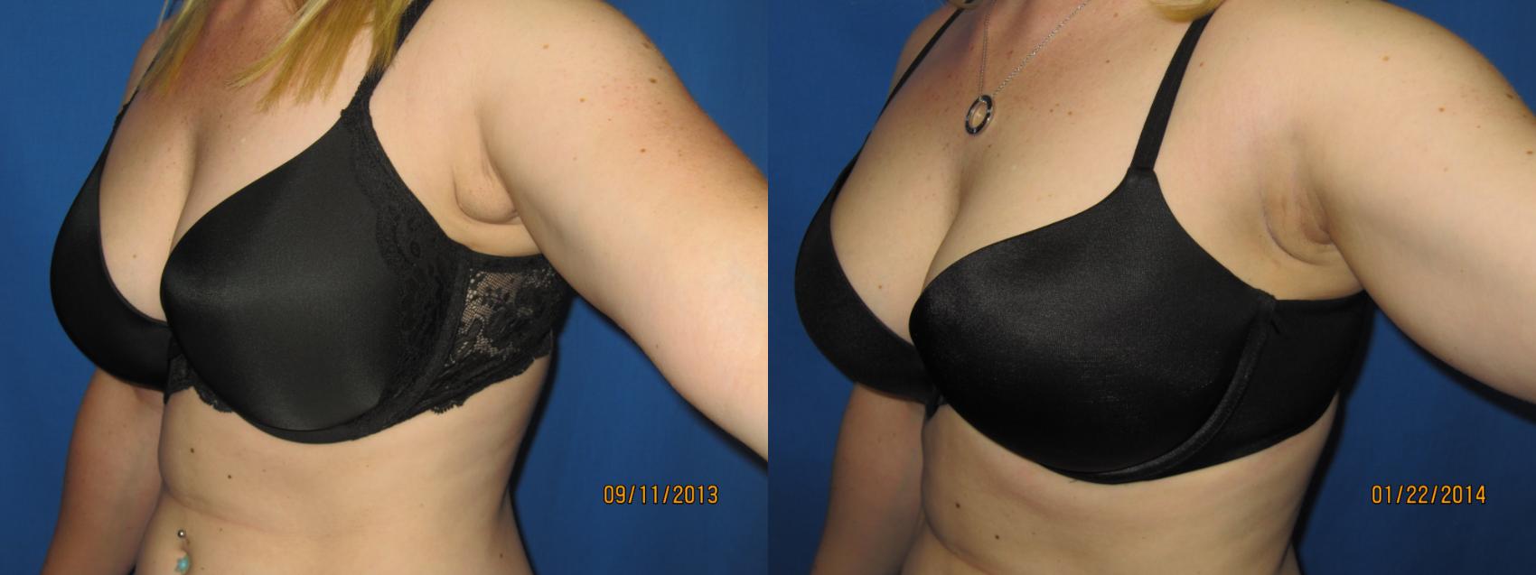 Before & After Liposuction - Arms / Axillary Case 48 View #1 View in Coeur d'Alene, ID