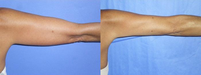 Before & After Liposuction - Arms / Axillary Case 5 View #1 View in Coeur d'Alene, ID