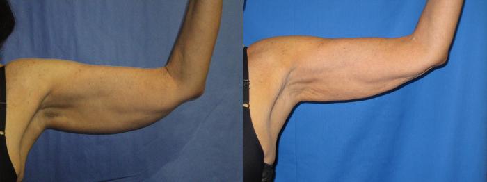 Before & After Liposuction - Arms / Axillary Case 6 View #1 View in Coeur d'Alene, ID