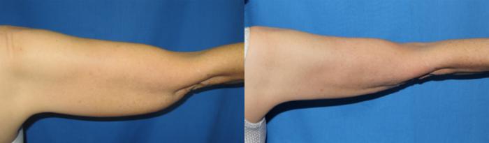 Axillary Puffs CoolSculpting Before & After Patient 02