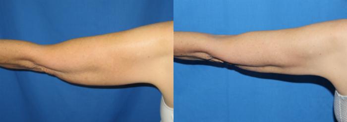 Before & After Liposuction - Arms / Axillary Case 68 View #2 View in Coeur d'Alene, ID