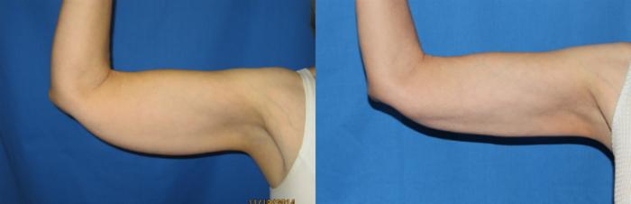 Before & After Liposuction - Arms / Axillary Case 68 View #3 View in Coeur d'Alene, ID