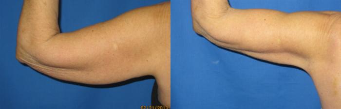 Before & After Liposuction - Arms / Axillary Case 69 View #3 View in Coeur d'Alene, ID