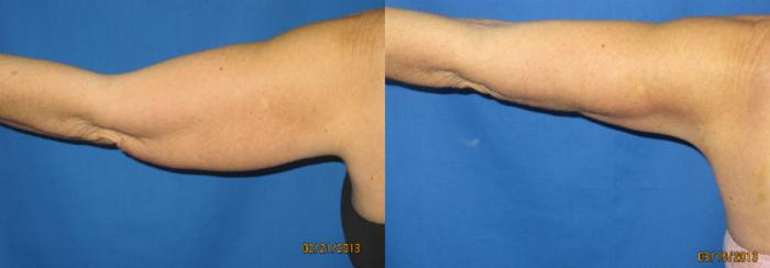 Before & After Liposuction - Arms / Axillary Case 69 View #4 View in Coeur d'Alene, ID