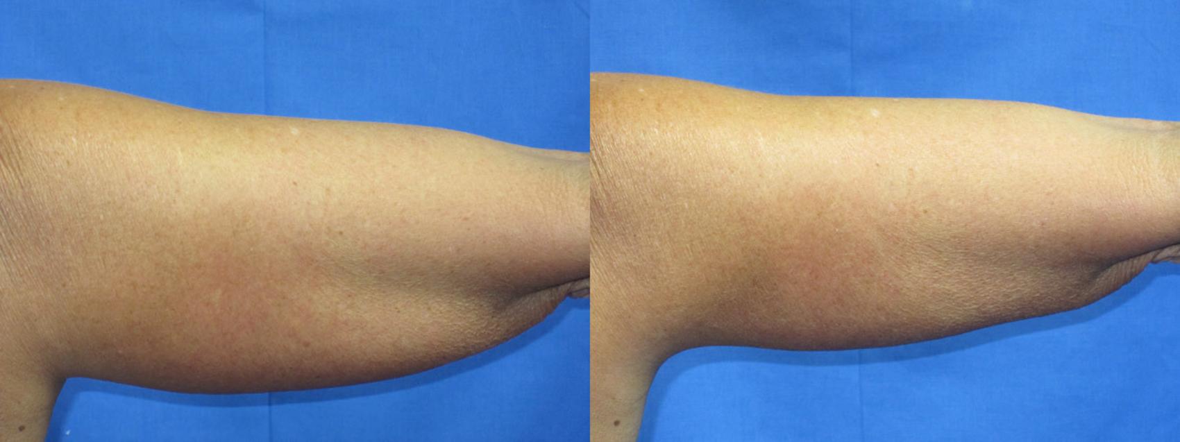 Before & After Liposuction - Arms / Axillary Case 7 View #1 View in Coeur d'Alene, ID