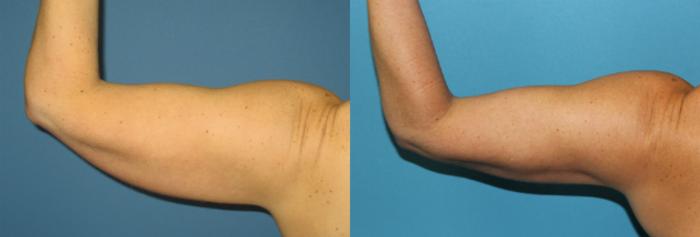 Liposuction - Arms / Axillary Before and After Pictures Case 48