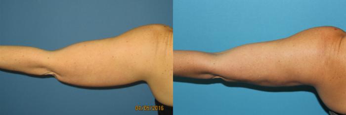 Before & After Liposuction - Arms / Axillary Case 72 View #2 View in Coeur d'Alene, ID