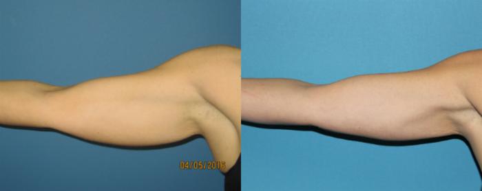 Before & After Liposuction - Arms / Axillary Case 72 View #3 View in Coeur d'Alene, ID