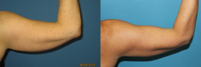 Before & After Liposuction - Arms / Axillary Case 72 View #4 View in Coeur d'Alene, ID