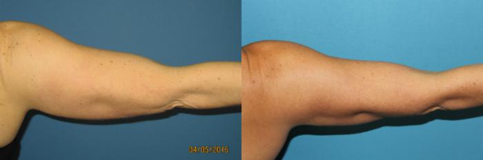 Before & After Liposuction - Arms / Axillary Case 72 View #5 View in Coeur d'Alene, ID