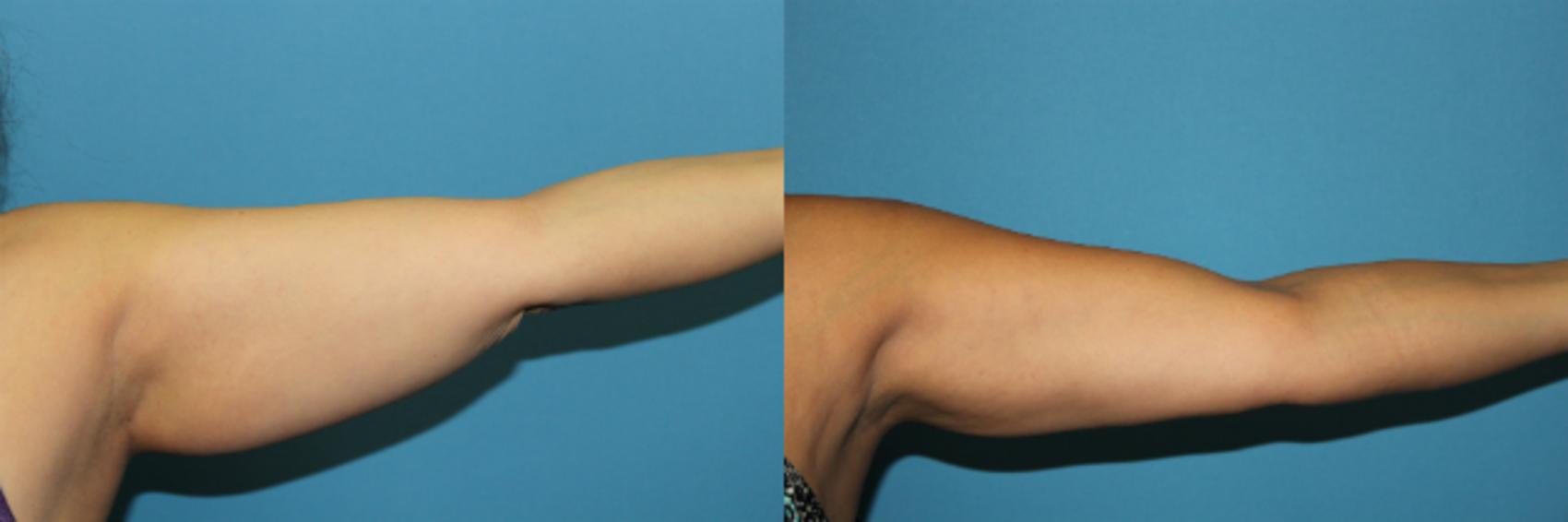 Before & After Liposuction - Arms / Axillary Case 87 View #1 View in Coeur d'Alene, ID