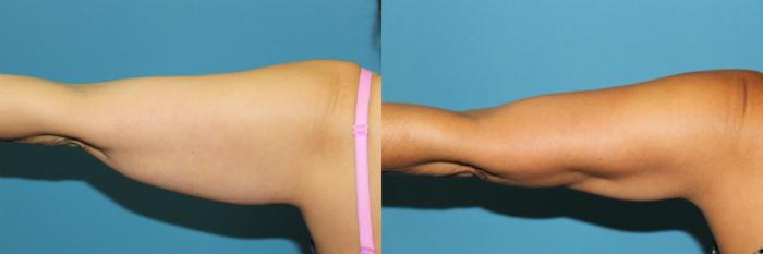Before & After Liposuction - Arms / Axillary Case 87 View #2 View in Coeur d'Alene, ID