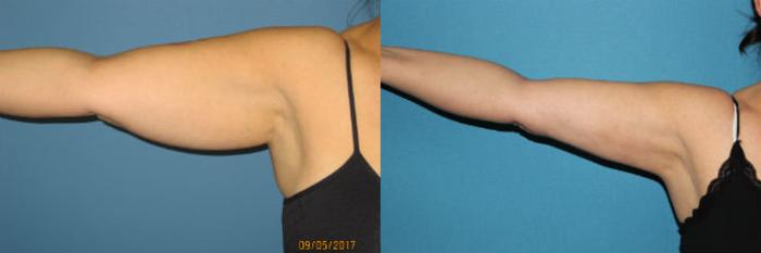 Arm and Axillary Liposuction