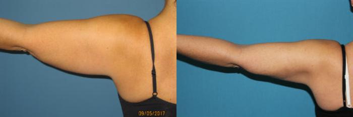 Before & After Liposuction - Arms / Axillary Case 96 View #2 View in Coeur d'Alene, ID