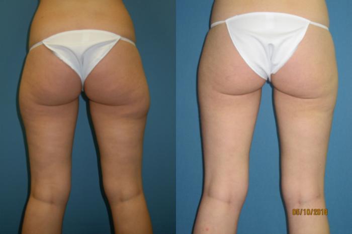 Before & After Liposuction - Inner and/or Outer Thighs Case 103 View #1 View in Coeur d'Alene, ID