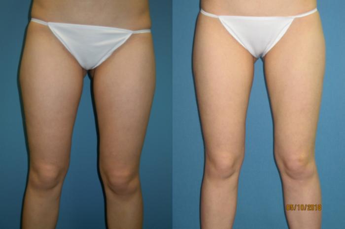Before & After Liposuction - Inner and/or Outer Thighs Case 103 View #2 View in Coeur d'Alene, ID