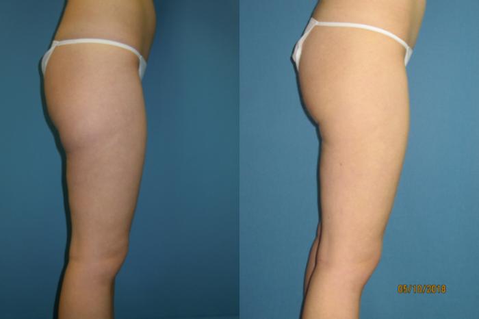 Before & After Liposuction - Inner and/or Outer Thighs Case 103 View #3 View in Coeur d'Alene, ID