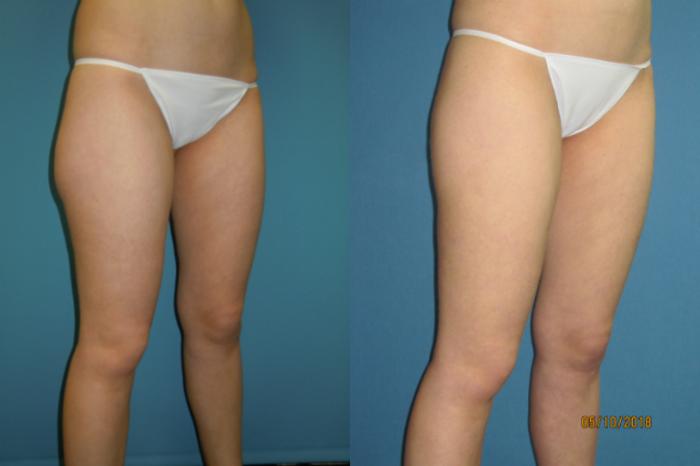 Before & After Liposuction - Inner and/or Outer Thighs Case 103 View #4 View in Coeur d'Alene, ID