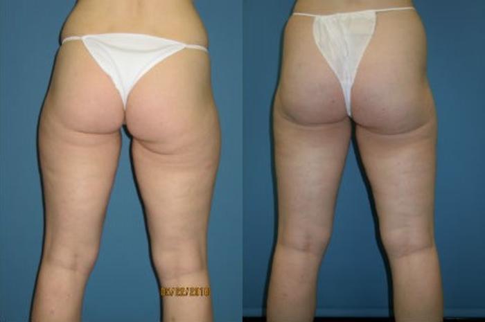 Before & After Liposuction - Inner and/or Outer Thighs Case 105 View #1 View in Coeur d'Alene, ID