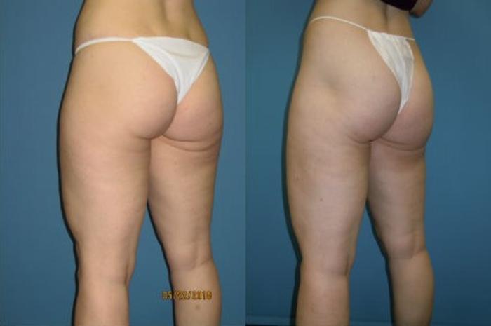 Before & After Liposuction - Inner and/or Outer Thighs Case 105 View #2 View in Coeur d'Alene, ID
