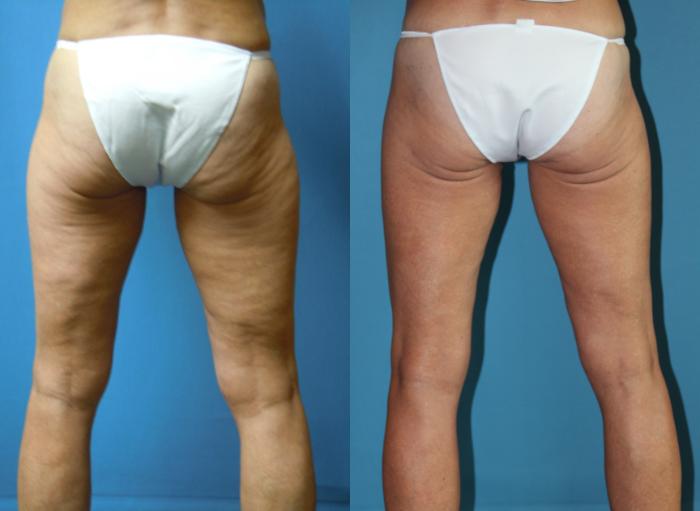 Before & After Liposuction - Inner and/or Outer Thighs Case 160 Back View in Coeur d'Alene, ID