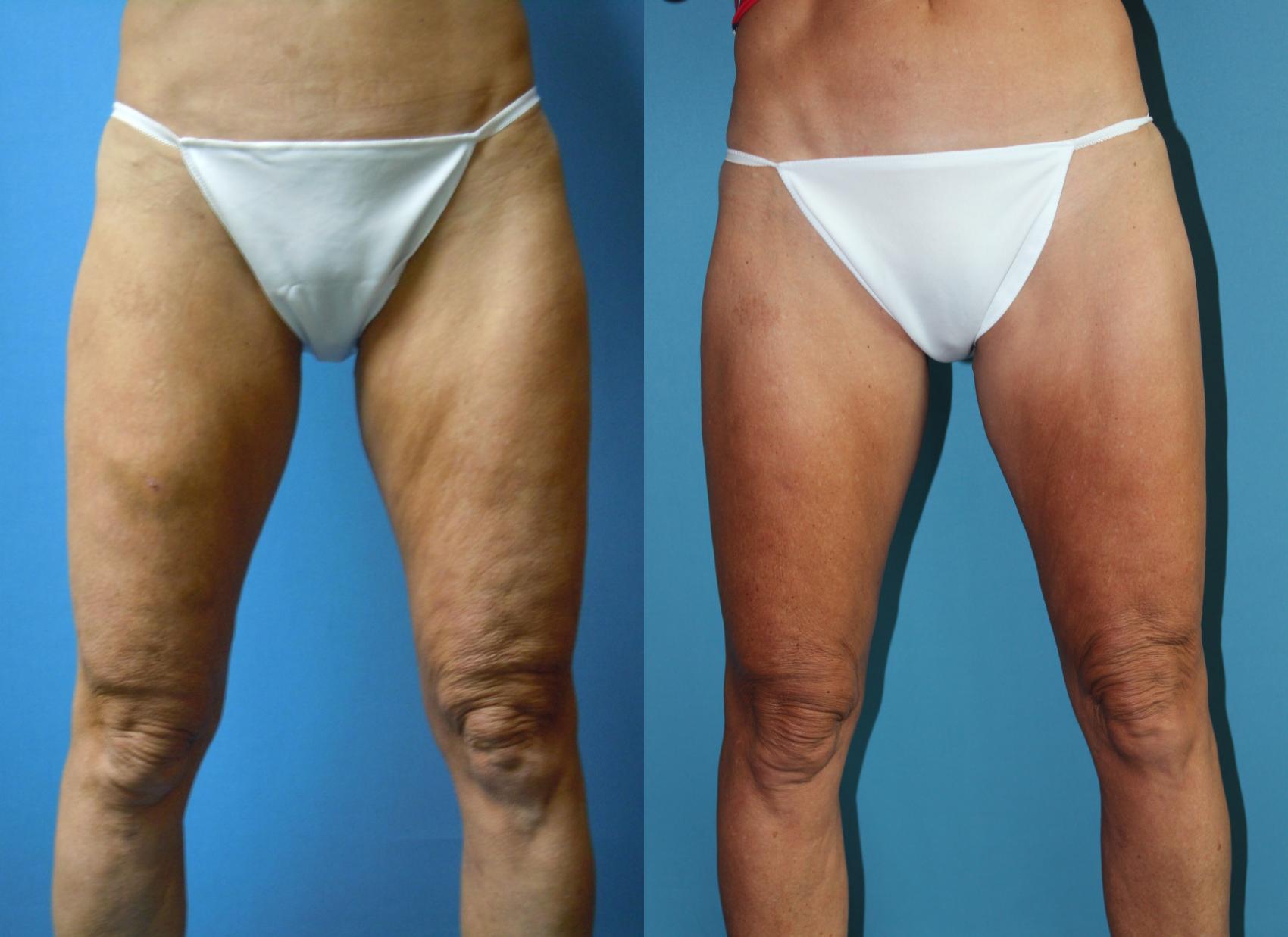 Before & After Liposuction - Inner and/or Outer Thighs Case 160 Front View in Coeur d'Alene, ID