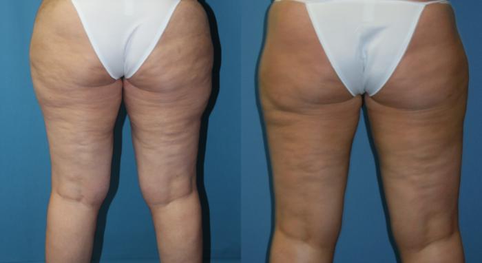 Back of thighs before liposuction to the inner and outer thigh- also Profound RF