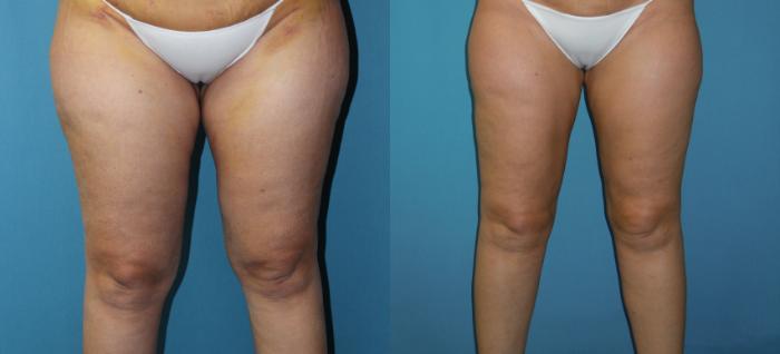 Front of thighs before liposuction to the inner and outer thigh- also Profound RF