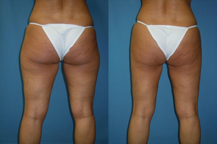 Before & After Liposuction - Inner and/or Outer Thighs Case 166 Back View in Coeur d'Alene, ID