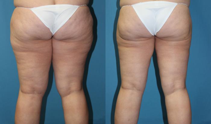 Before & After Liposuction - Inner and/or Outer Thighs Case 168 Back View in Coeur d'Alene, ID