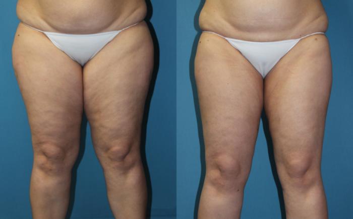 Before & After Liposuction - Inner and/or Outer Thighs Case 168 Front View in Coeur d'Alene, ID