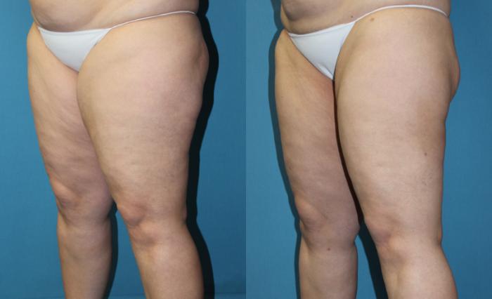 Before & After Liposuction - Inner and/or Outer Thighs Case 168 Left Oblique View in Coeur d'Alene, ID