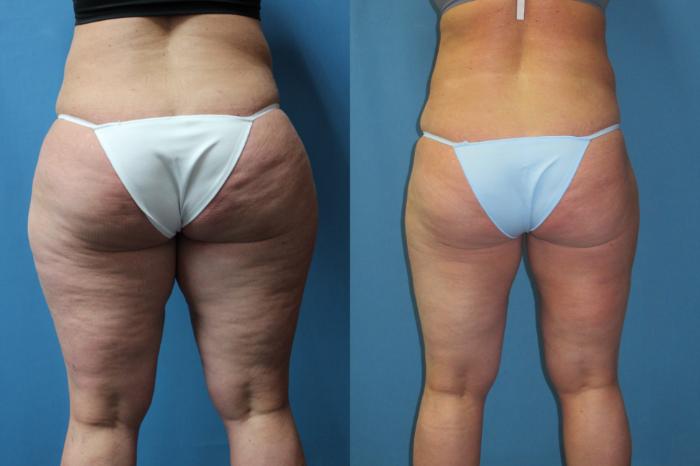 Before & After Liposuction - Inner and/or Outer Thighs Case 178 Back View in Coeur d'Alene, ID