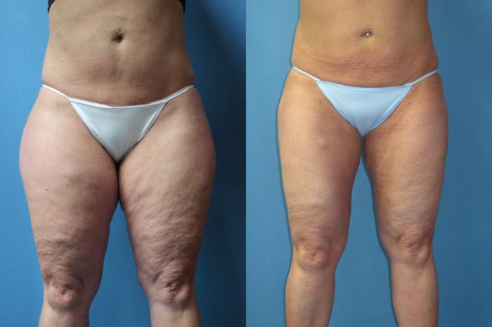 Slimmer thighs, Cellulite treatment, will wear shorts