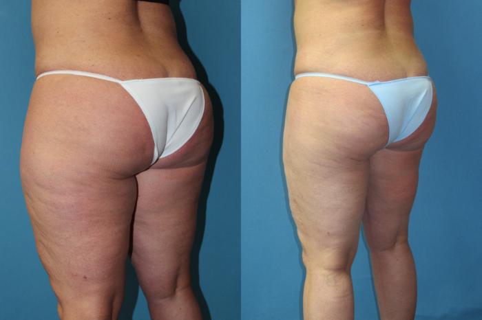 Before & After Liposuction - Inner and/or Outer Thighs Case 178 Left Oblique View in Coeur d'Alene, ID
