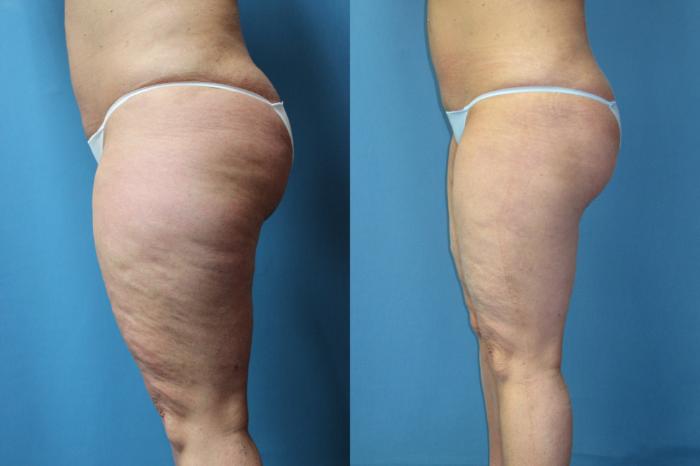 Before & After Liposuction - Inner and/or Outer Thighs Case 178 Left Side View in Coeur d'Alene, ID