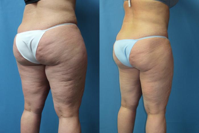 Before & After Liposuction - Inner and/or Outer Thighs Case 178 Right Oblique View in Coeur d'Alene, ID