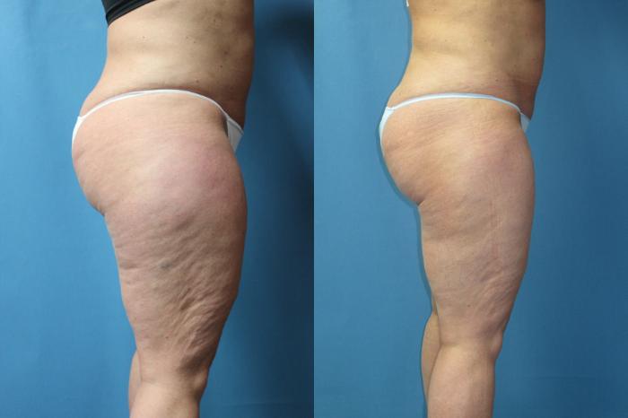 Before & After Liposuction - Inner and/or Outer Thighs Case 178 Right Side View in Coeur d'Alene, ID