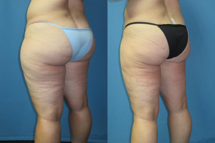 Before & After Liposuction - Inner and/or Outer Thighs Case 186 Back Oblique  View in Coeur d'Alene, ID
