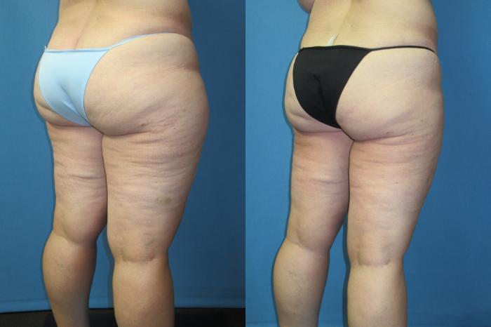 Before & After Liposuction - Inner and/or Outer Thighs Case 186 Back Oblique - Right side View in Coeur d'Alene, ID