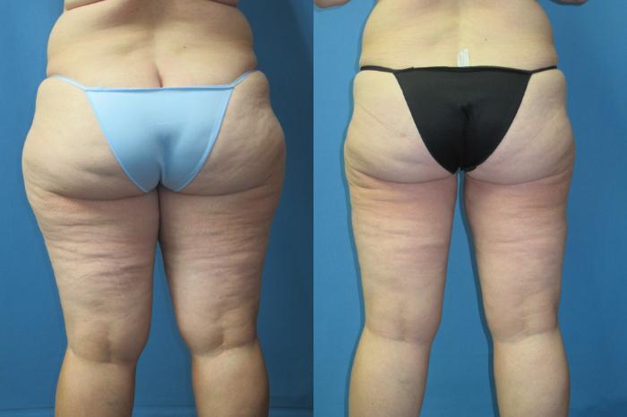 Before & After Liposuction - Inner and/or Outer Thighs Case 186 Back View in Coeur d'Alene, ID