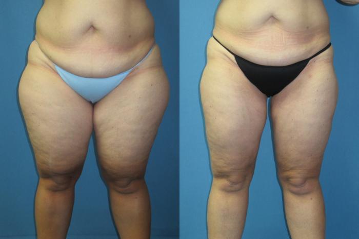 Before & After Liposuction - Inner and/or Outer Thighs Case 186 Front View in Coeur d'Alene, ID