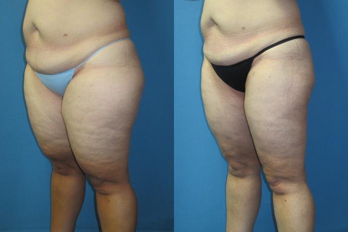 Before & After Liposuction - Inner and/or Outer Thighs Case 186 Left Oblique View in Coeur d'Alene, ID