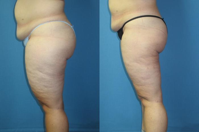 Before & After Liposuction - Inner and/or Outer Thighs Case 186 Left Side View in Coeur d'Alene, ID
